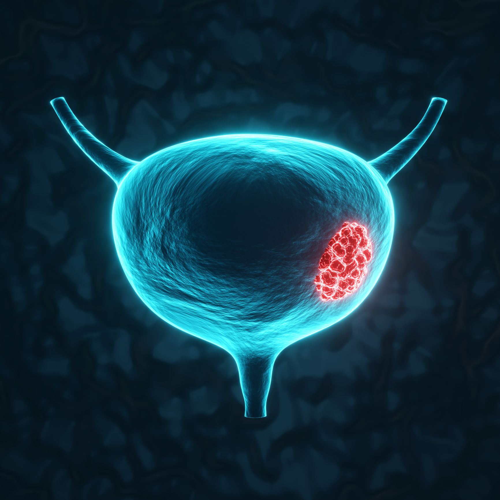 Bladder with highlighted cancerous area