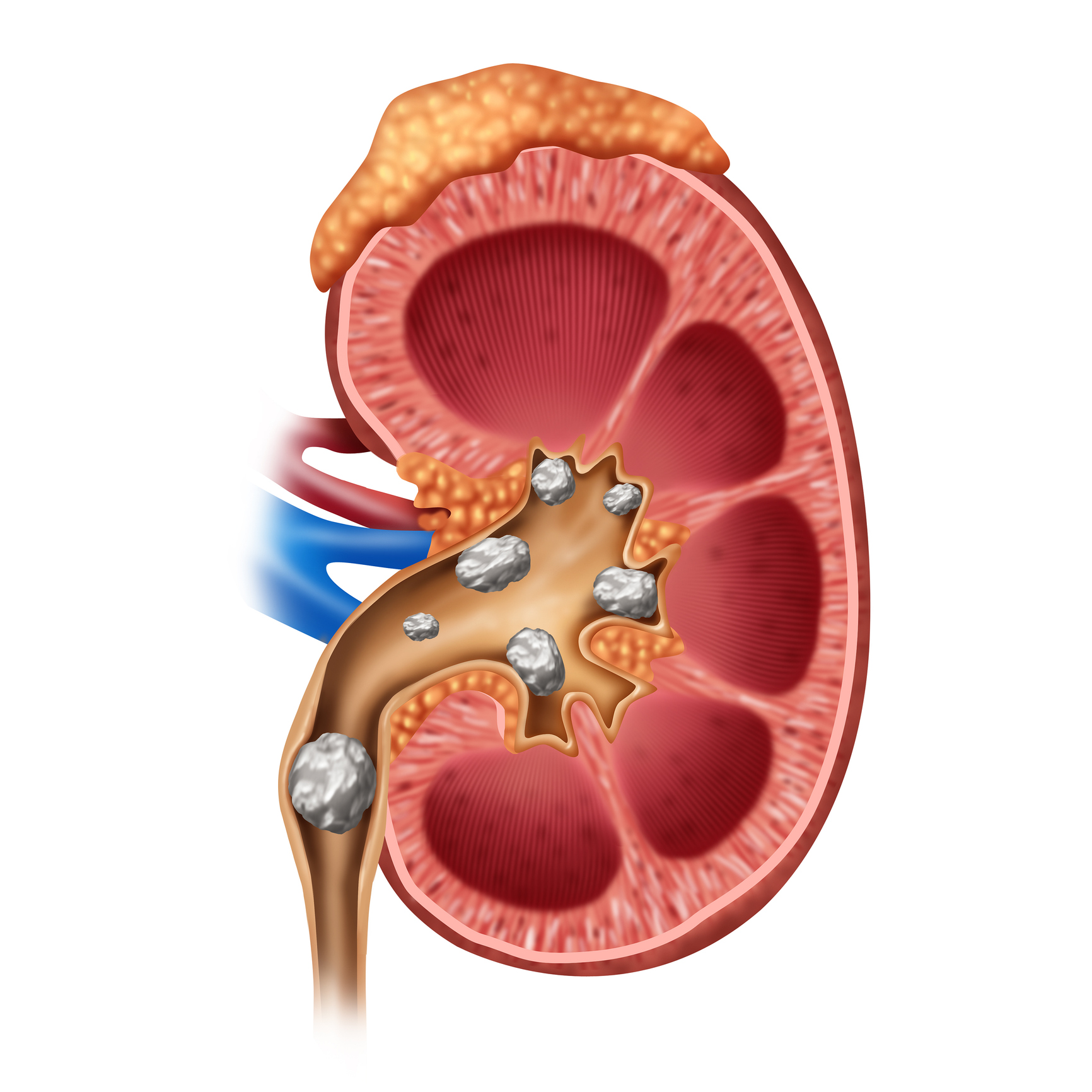 Kidney with stones illustration