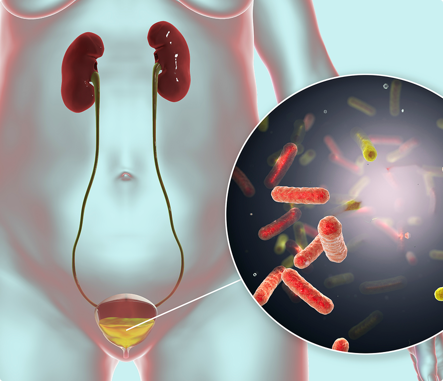 Urinary tract infection illustration