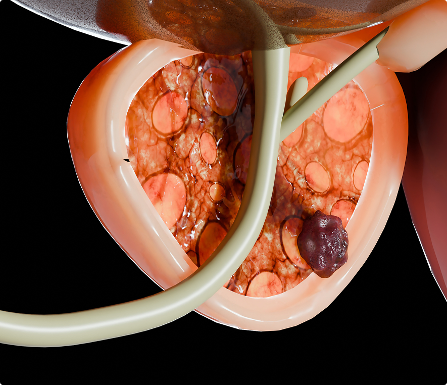 Cross-section of human prostate with tumor