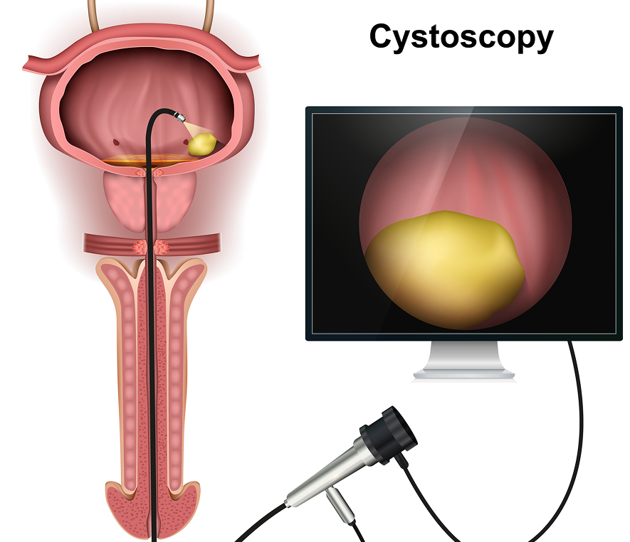Medical diagram of cystoscopy examination