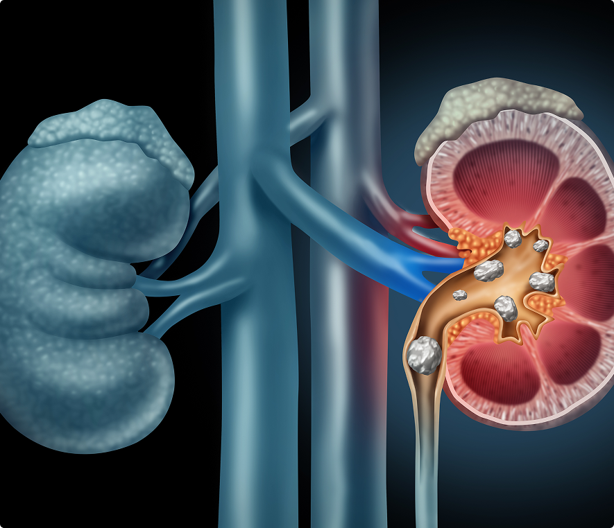 Medical illustration of kidney stone formation.