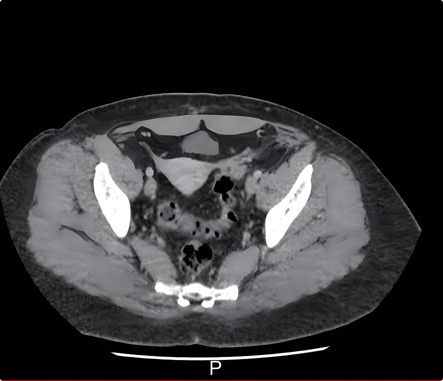CT scan of pelvic region