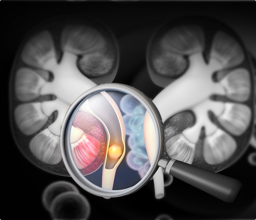 Illustration of kidney stones formation