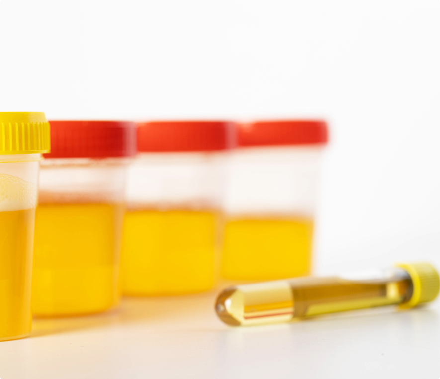 Medical urine specimen containers and vial